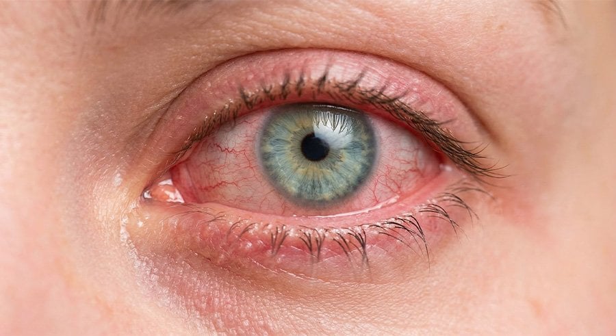 Hassas kornea ve alerjik göz yapısı olan kişilerde lensle havuza girme riski