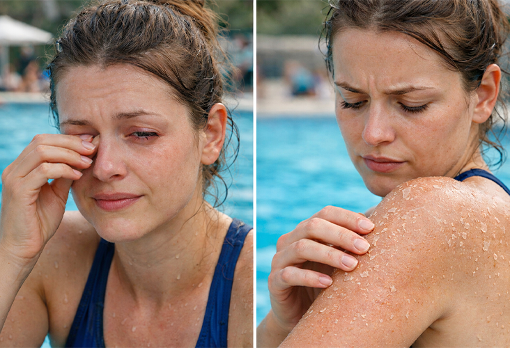 Havuz kloru sonrası göz tahrişi ve cilt kuruluğu: yüzme sonrası etkiler