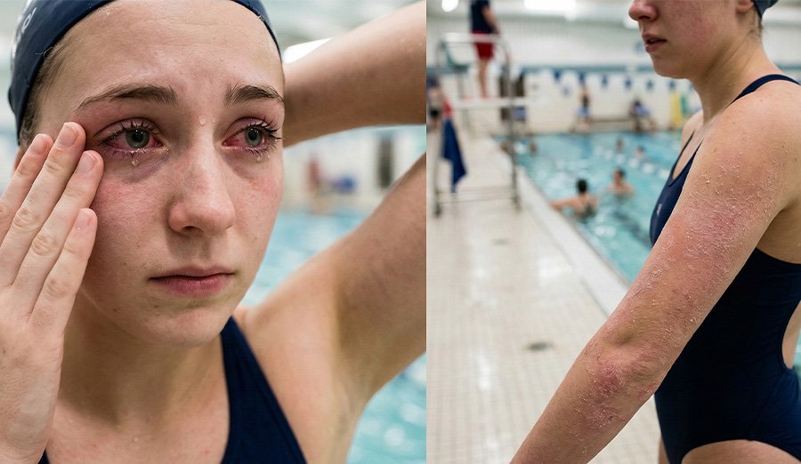 havuzda-yuksek-klor-seviyesi-goz-yanmasi-ve-cilt-tahrisi