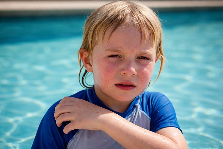 Klorlu havuz sonrası cilt hassasiyeti ve kızarıklık yaşayan çocuk